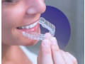 invisible-braces-in-faridabad-small-0