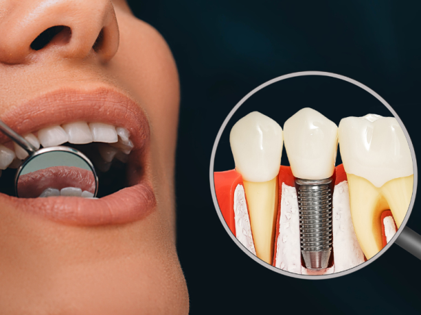 dental-implants-in-faridabad-big-0