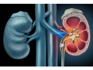 Kidney Specialist in Bangalore