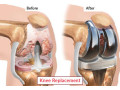 knee-replacement-surgery-procedure-benefits-recovery-in-zimbabwe-small-0