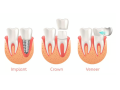 same-day-crowns-in-las-vegas-at-functional-aesthetic-dentistry-small-0
