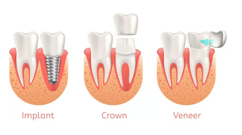 same-day-crowns-in-las-vegas-at-functional-aesthetic-dentistry-big-0
