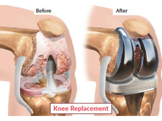 Die groei van knievervanging chirurgie in Afrika: voordele en uitdagings