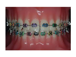 Straighten Your Smile with Expert Orthodontics in Katy, TX