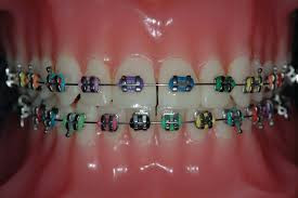 straighten-your-smile-with-expert-orthodontics-in-katy-tx-big-0