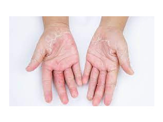 Effectively treat bacterial skin infections with Mupirocin 2% ointment
