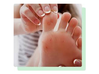 Warts On Feet Treatment Elizabeth